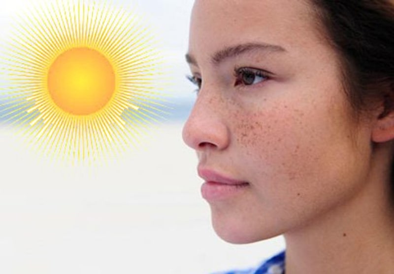 Cách trị nám da do nắng hiệu quả có thể áp dụng tại nhà