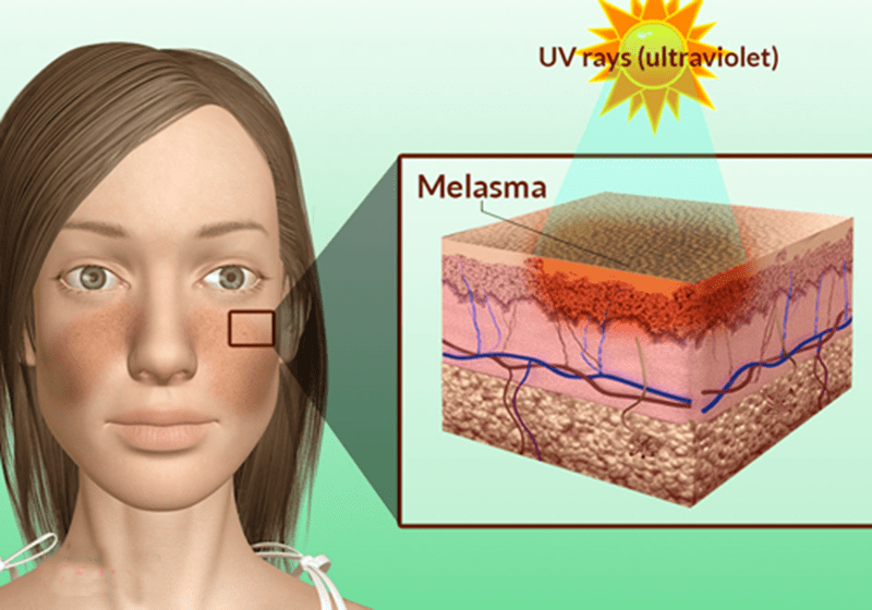 Đi biển bị nám da là do tác động của tia UV kích thích sản sinh Melanin