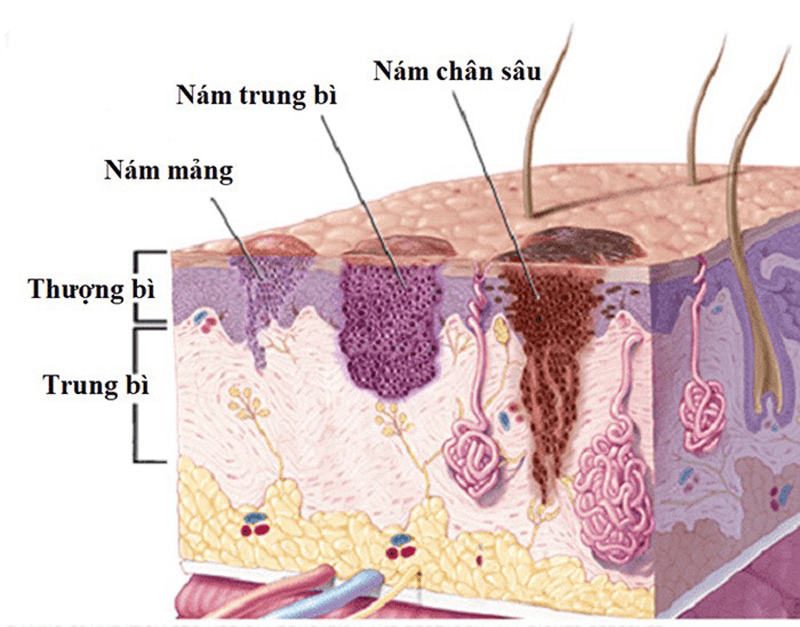 Nám khói có chân nám sâu hơn cả nám mảng, nám chân sâu