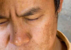 Nám da ở nam giới: Nguyên nhân bị nám da và cách điều trị