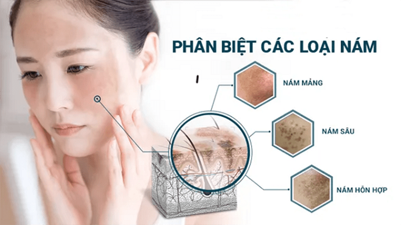 Dấu hiệu nhận biết nám da ở tuổi 30